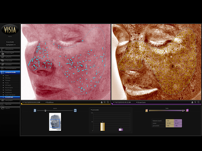 VISIA skin analysis