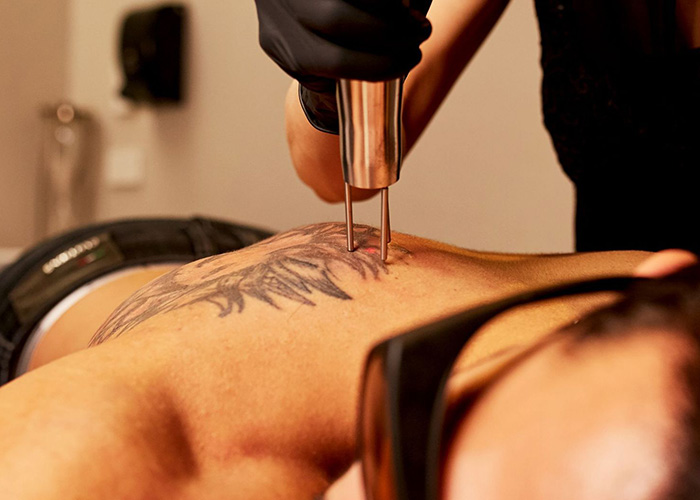 How Painful Is Tattoo Removal | Face of Man Sydney