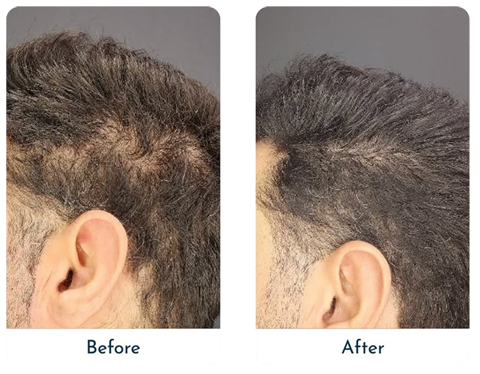 close up of male head hair restoration before and after result