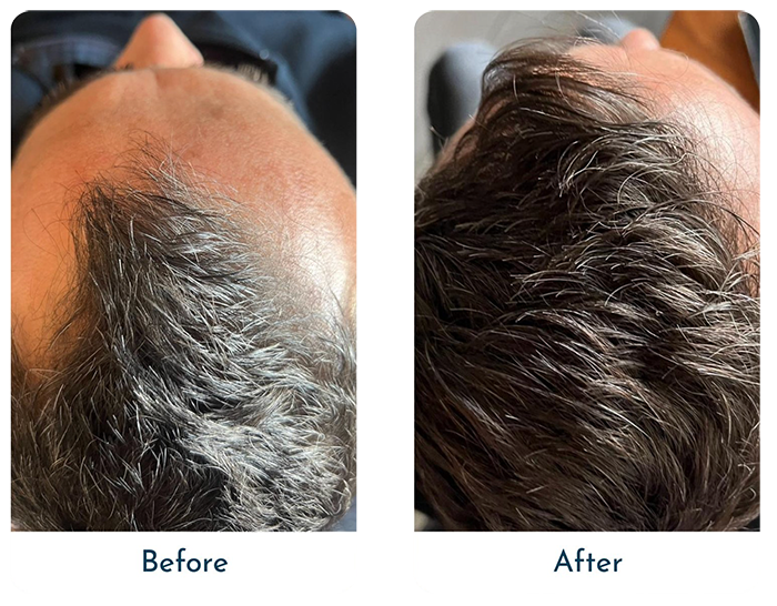 close up of male head hair restoration before and after result