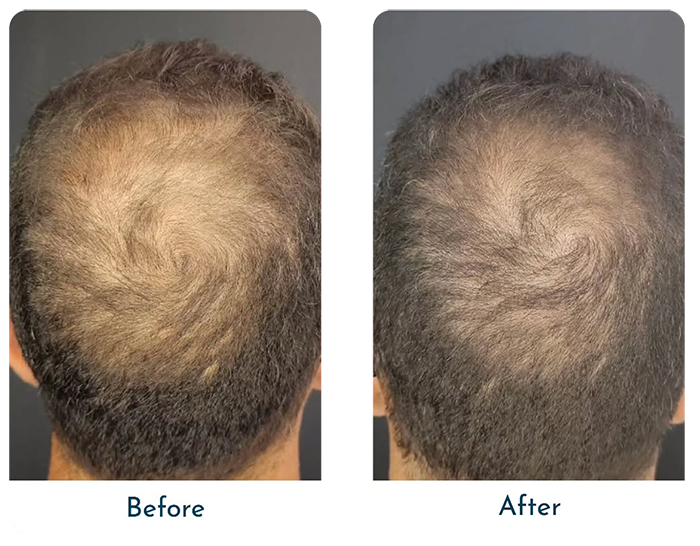 close up of male head hair restoration before and after result