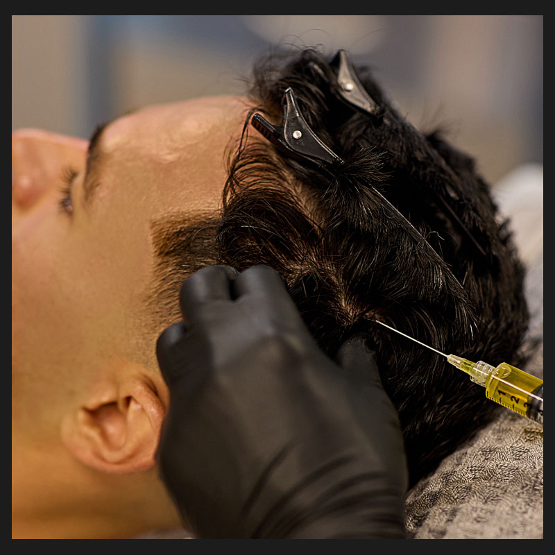 Closeup of prp treatment on male's head