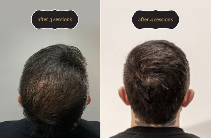 Ash hair restore client and his before and after results