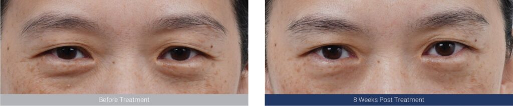 Ultraformer Powerlift package before and after results